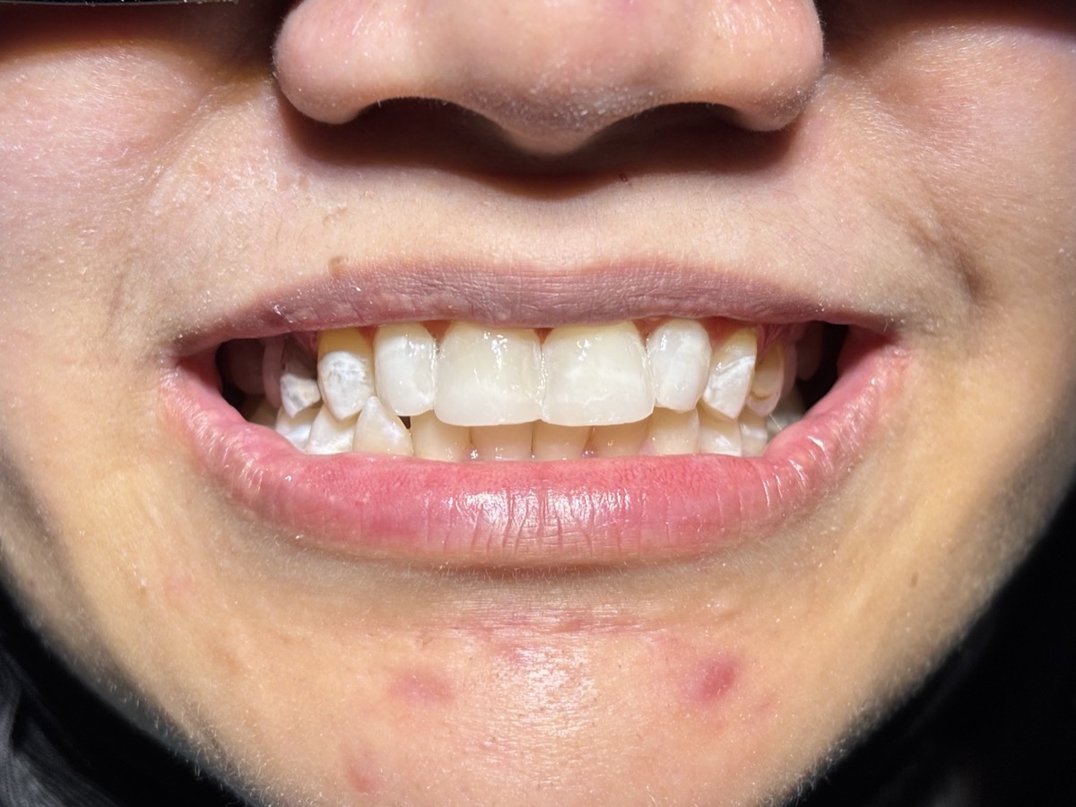 Composite veneer treatment
