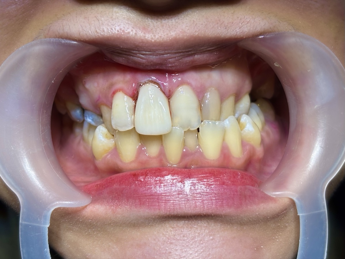 Dental crown treatment