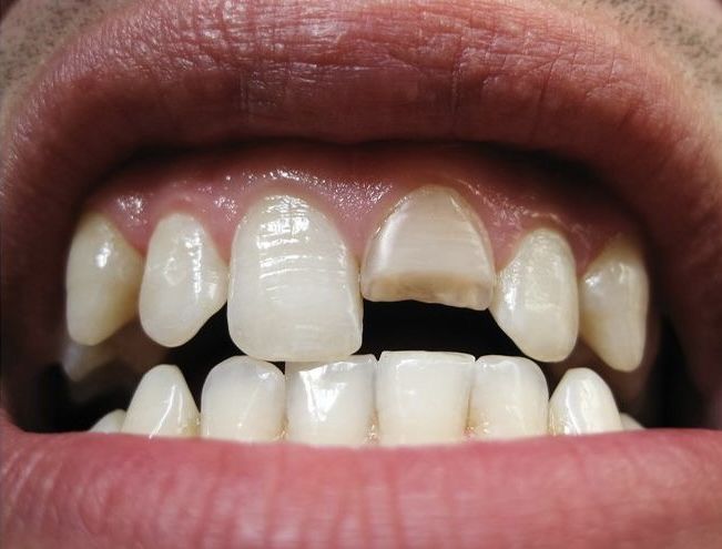 Chipped tooth example