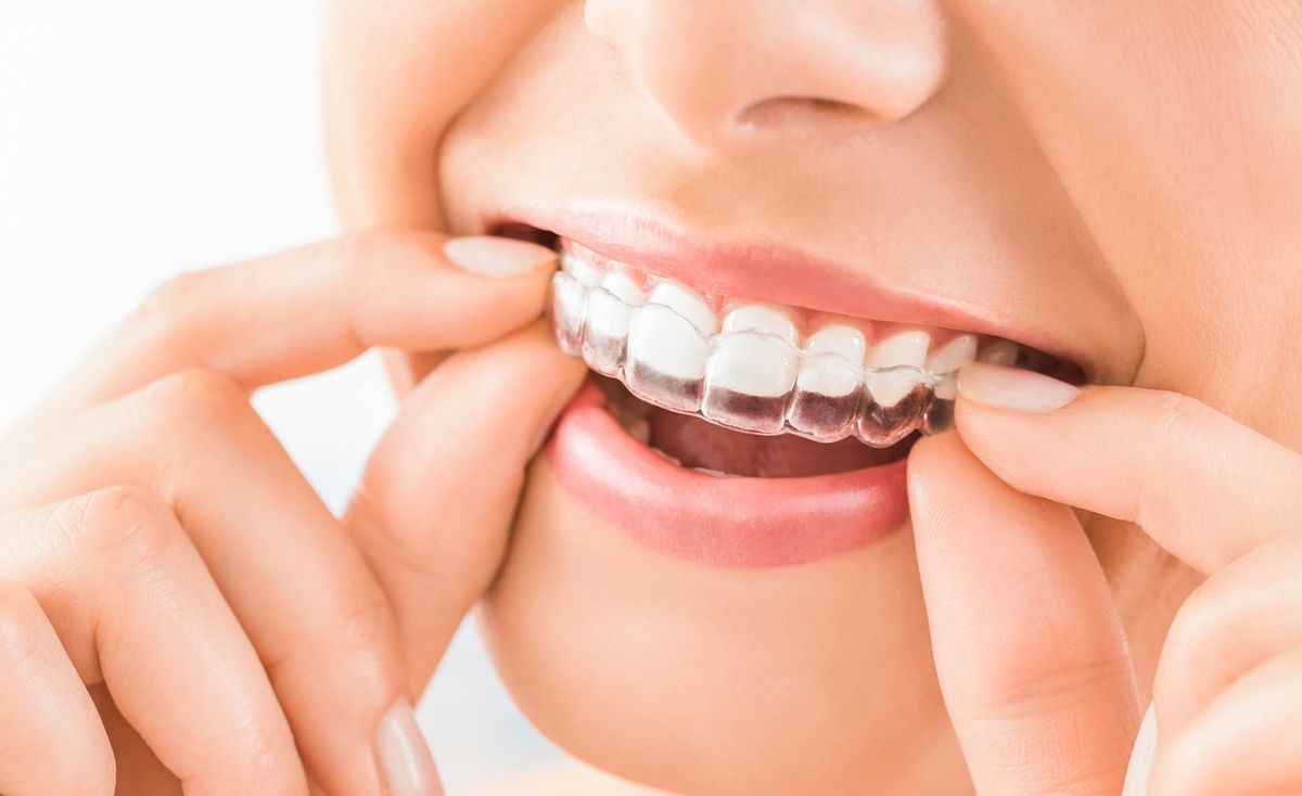 Clear aligner treatment