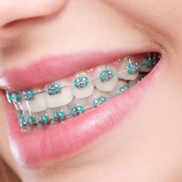 Conventional braces treatment