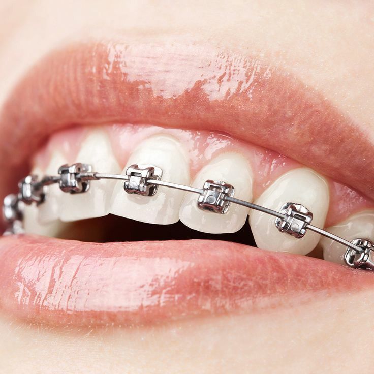 Self-ligating braces treatment