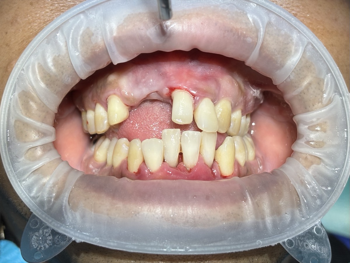 Missing teeth example