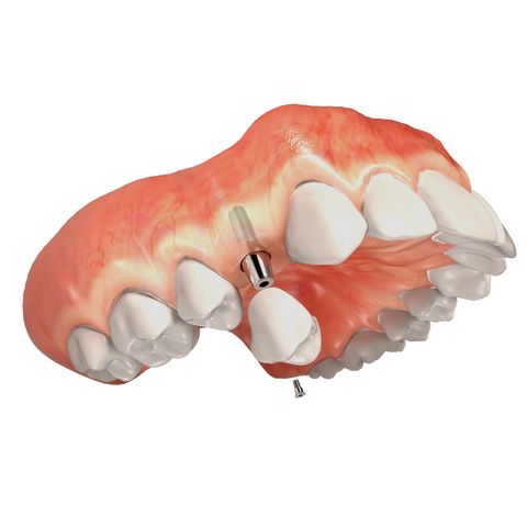 Dental implant treatment