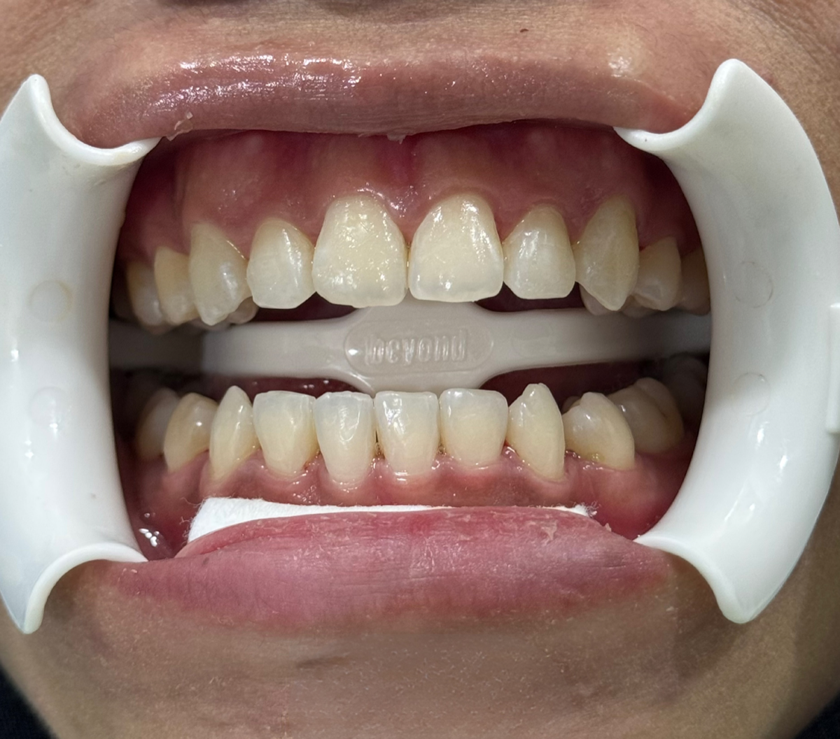 Whitening treatment example