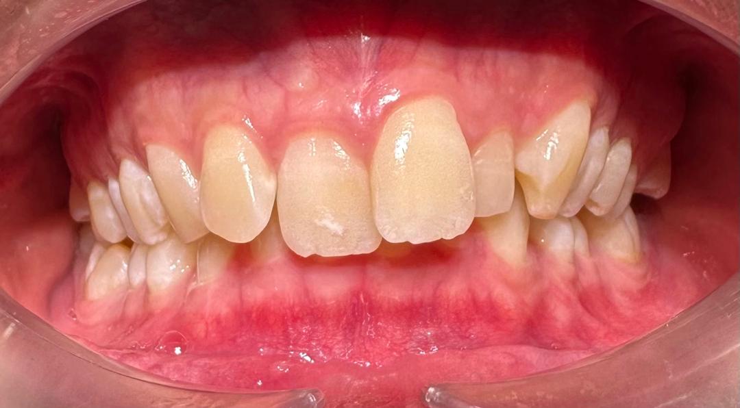 Before - Conventional Braces