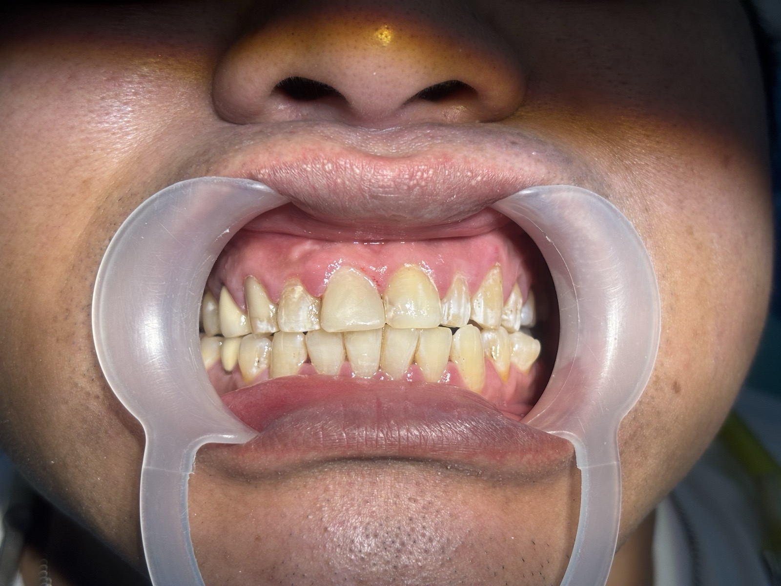 After - Dental Restoration