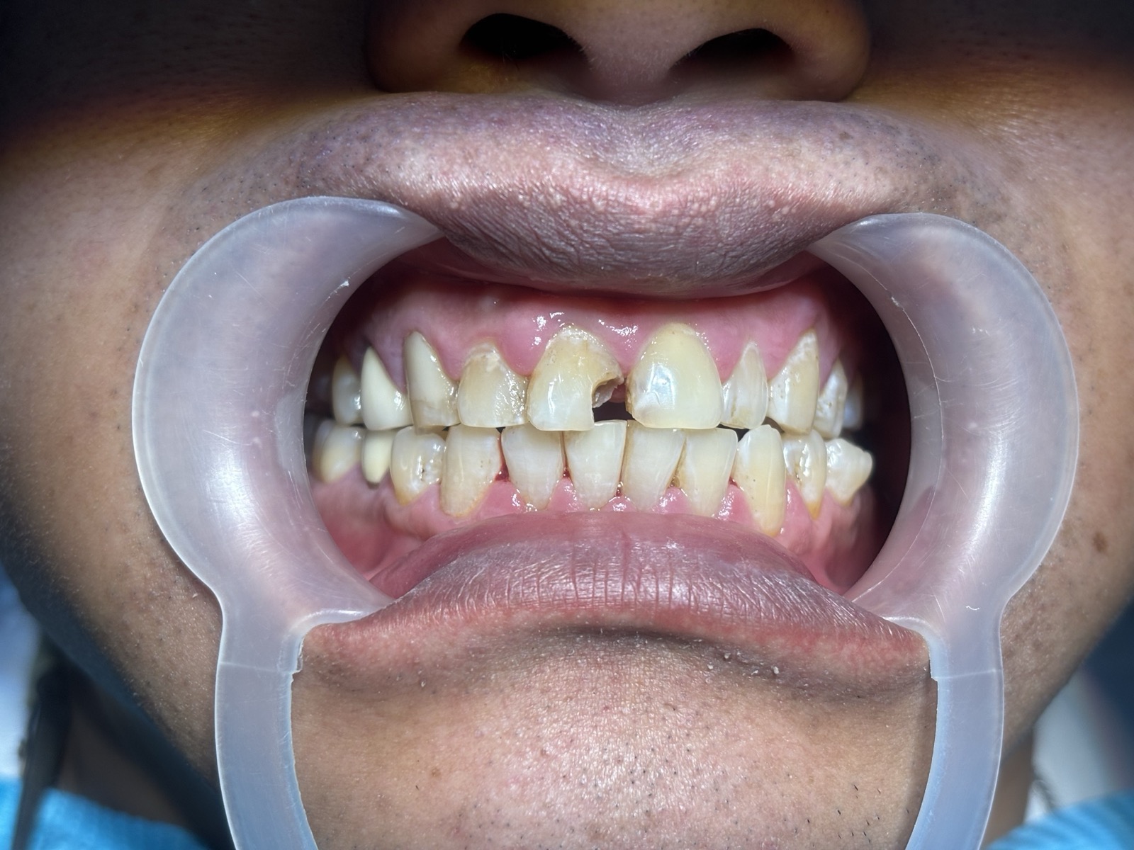 Before - Dental Restoration