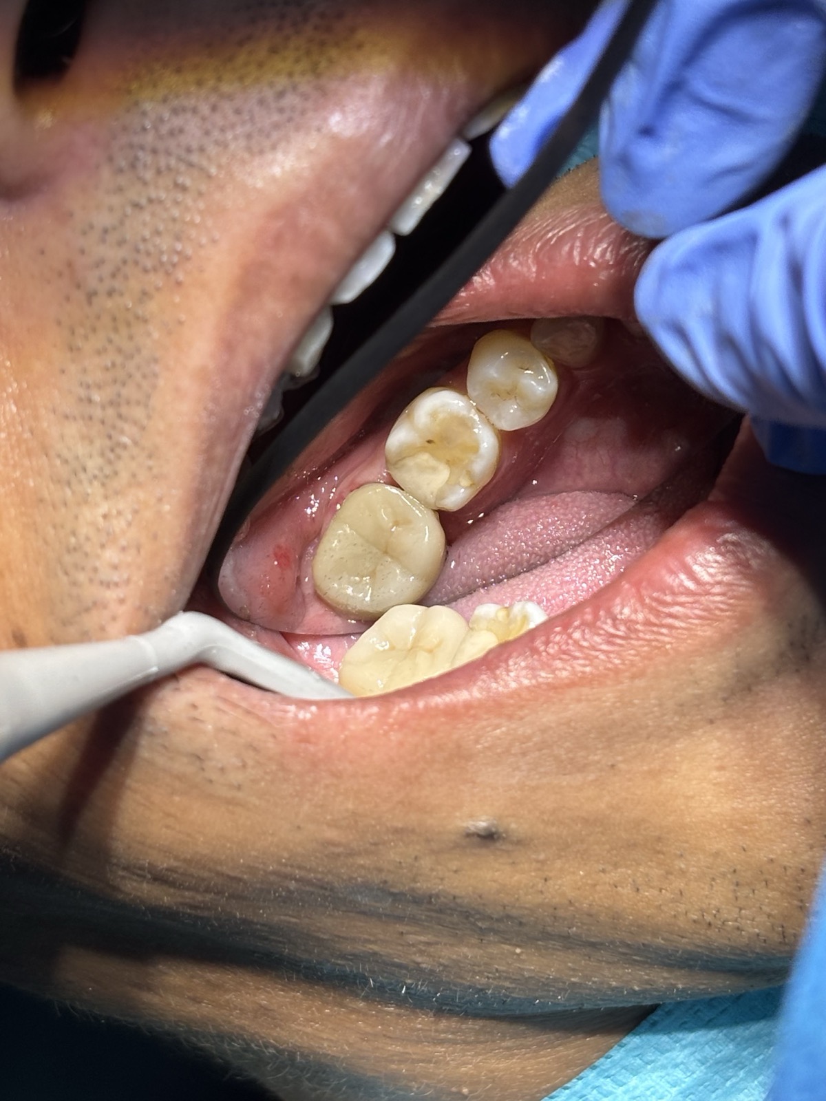 After - Root Canal Treatment