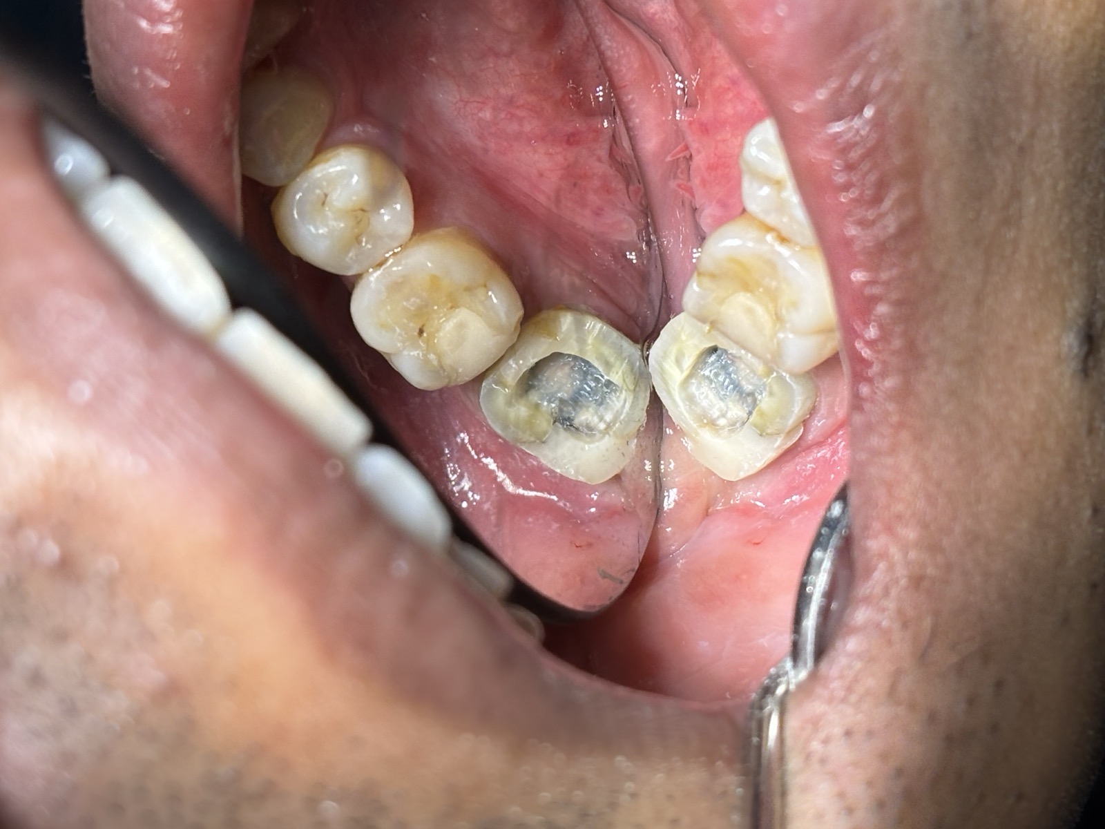 Before - Root Canal Treatment