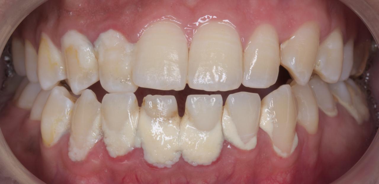 Before - Scaling & Polishing