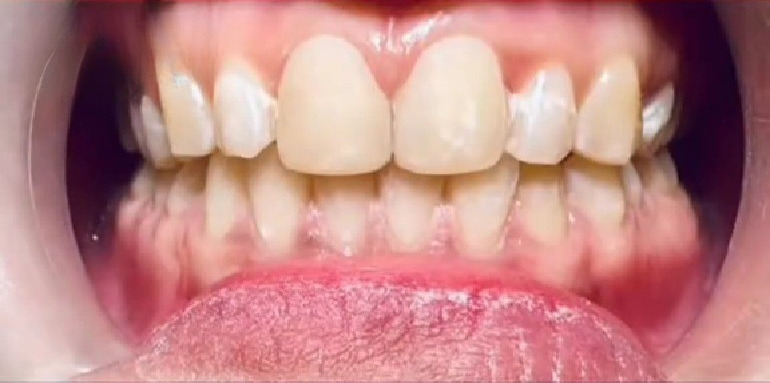 After - Veneer