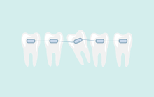 Orthodontics treatment