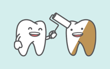 Professional teeth whitening treatment